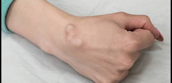 الأكياس العقدية